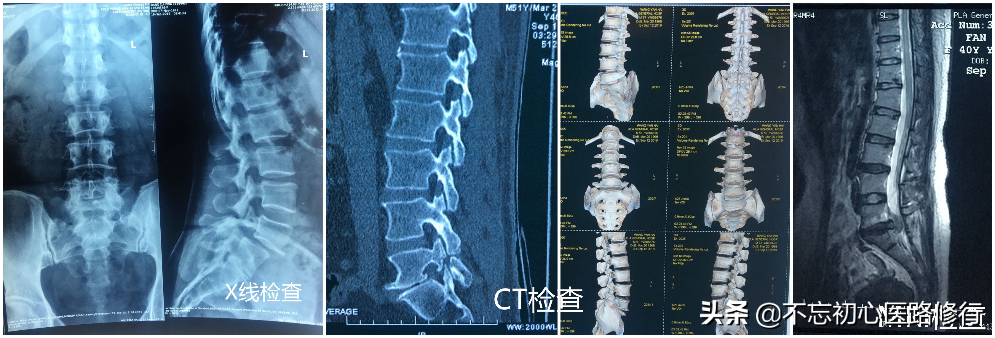 治疗腰椎间盘突出的方法与思路,腰椎间盘突出腰腿酸痛多久能好