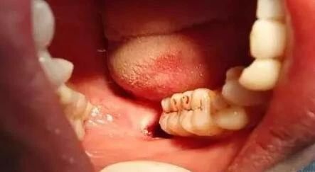 月经期第几天拔牙最好,月经期不能拔智齿