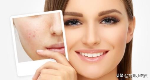 脸上长痘痘身上长痘的原因,脸上平常不长痘痘突然长痘痘