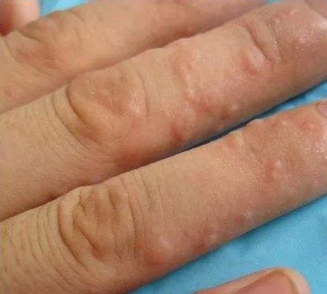 汗疱疹是不是长水泡一挠就变大,手上有小疱疹挠坏了有水