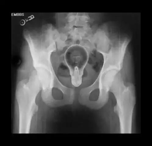 异物进入直肠?先别嫌丢人,赶紧去看医生吧