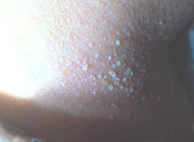 宝宝热出痱子婆婆说烂胎盘,高温天气宝宝热痱子怎么治好得快