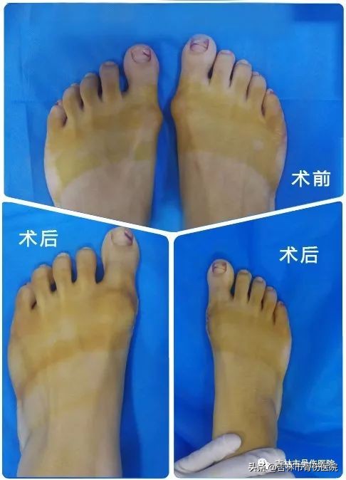 大脚骨对女性的危害很大,大脚骨的危害图片