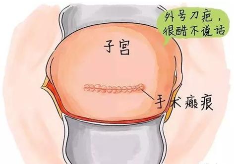 子宫疤痕妊娠什么意思,瘢痕子宫会导致胎停吗