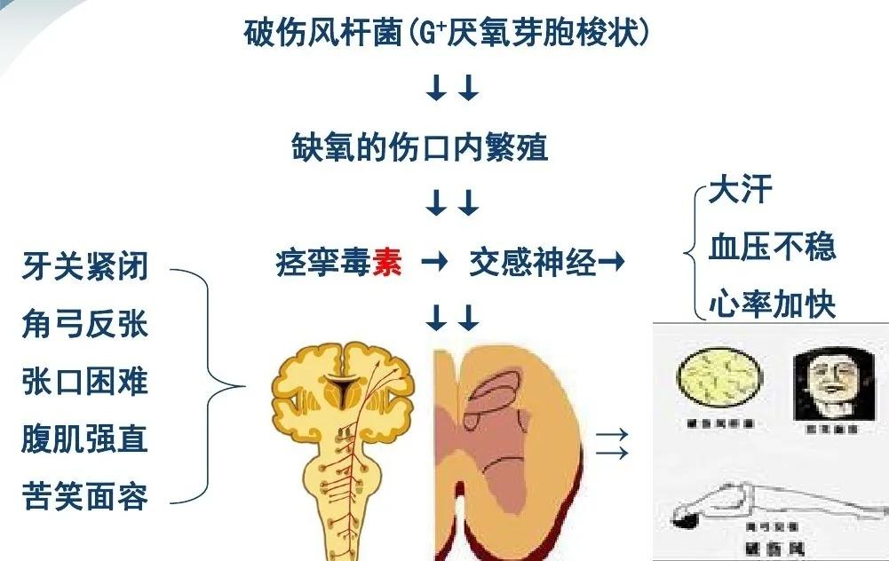 破伤风其实没那么可怕,科普关于破伤风的一些事儿