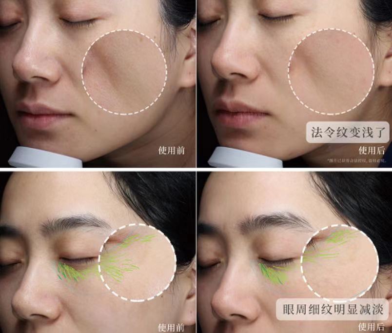 王鸥谈打了瘦脸针,王鸥打过瘦脸针吗