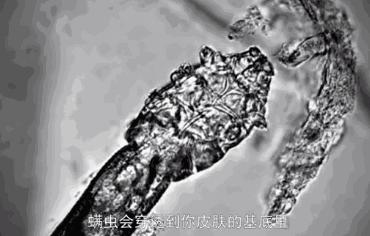 后背长痘的原因和改善方法,后背长痘太可怕了该怎样调理