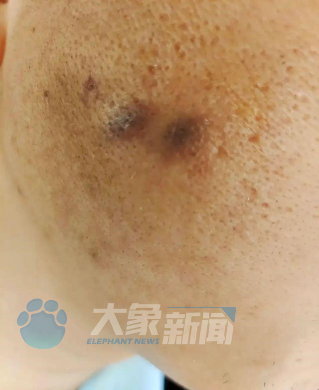 陕西西安高管聚会烟头烫伤员工,用烟头烫员工脸的高管已被免职