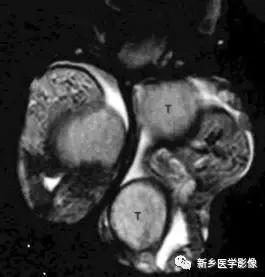 睾丸内部病变,睾丸病变mri