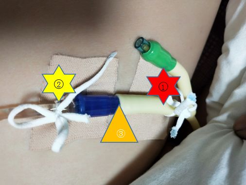 给患者插入导尿管,固定位置很重要