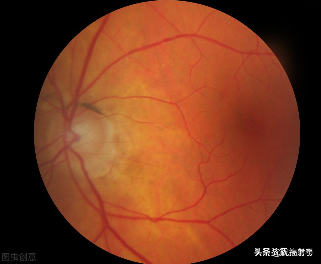 专家谈老年飞蚊症的治疗,飞蚊症老年人