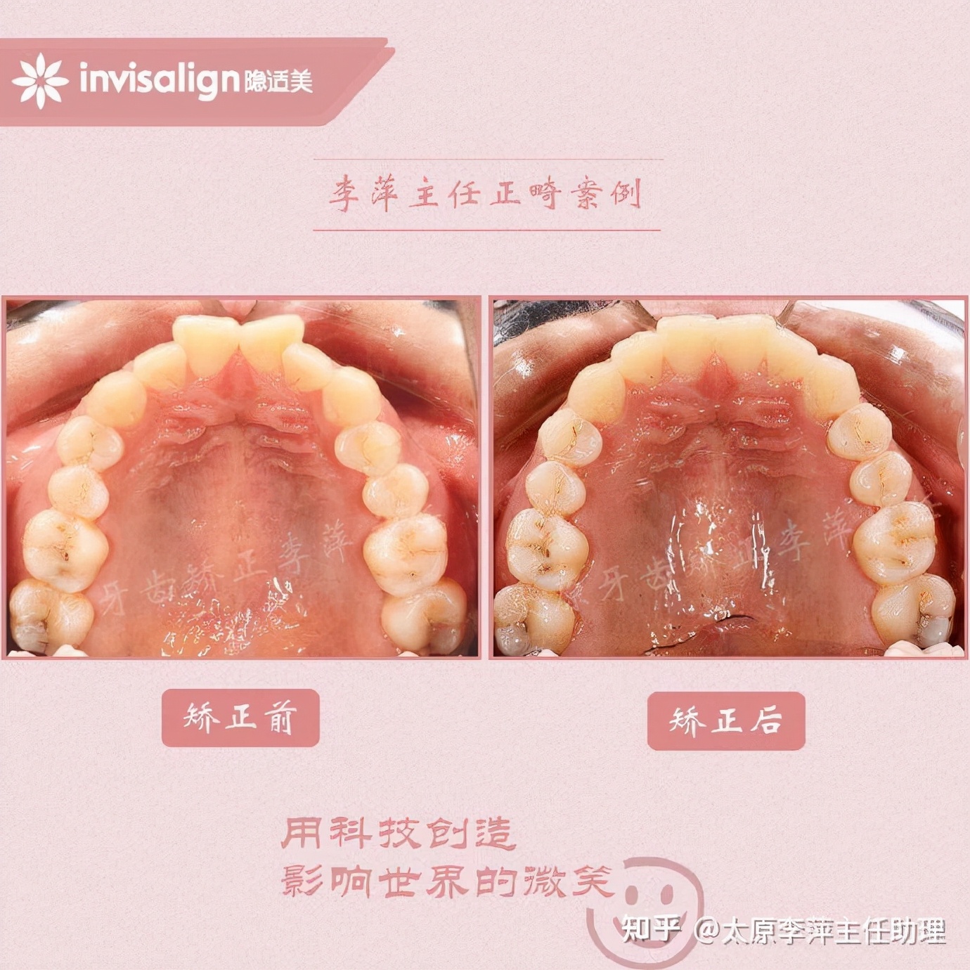 太原牙齿矫正靠谱吗,太原成人隐形牙套牙齿不齐