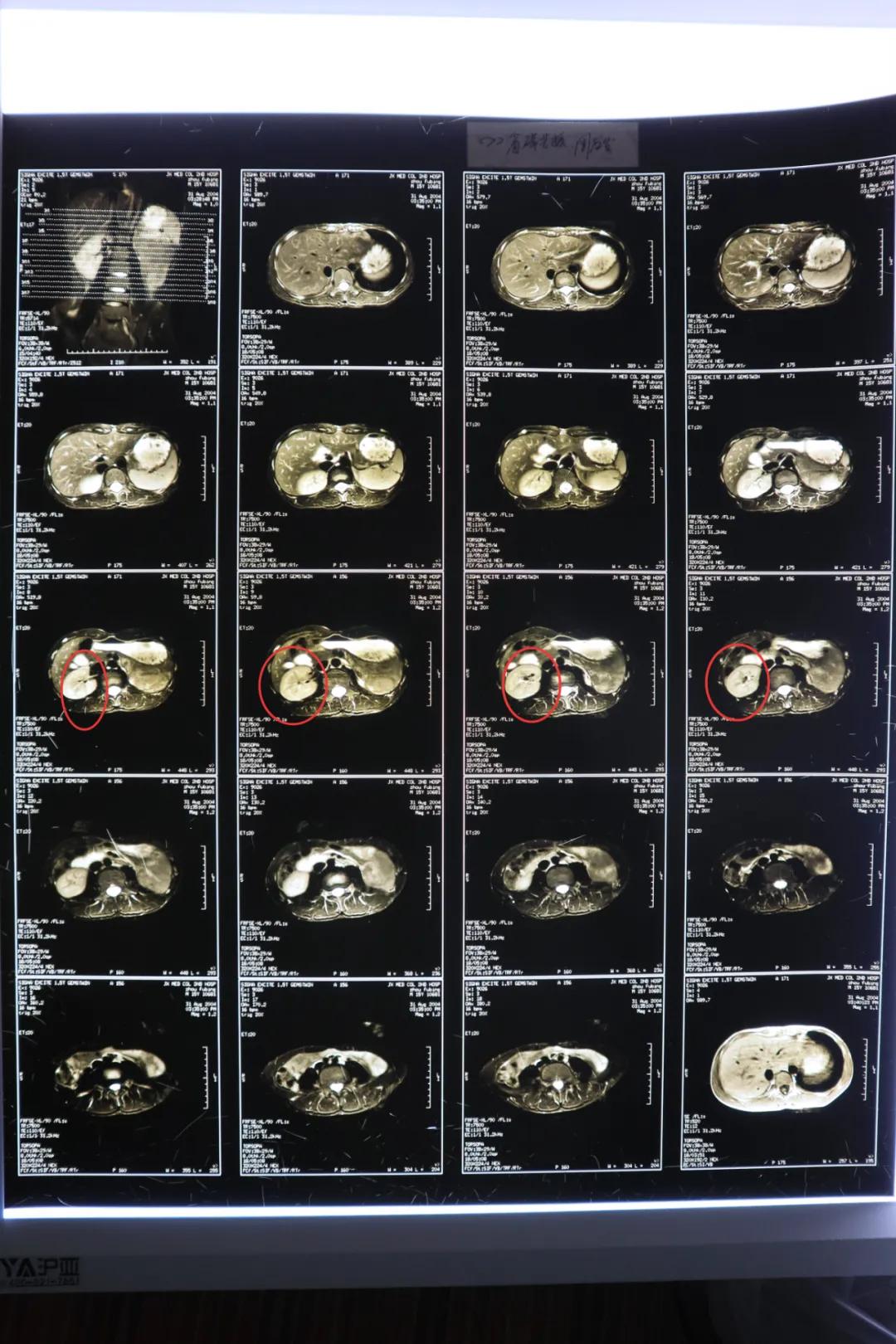 做完手术几年后发现丢了一个肾,男子一场手术后肾不见了