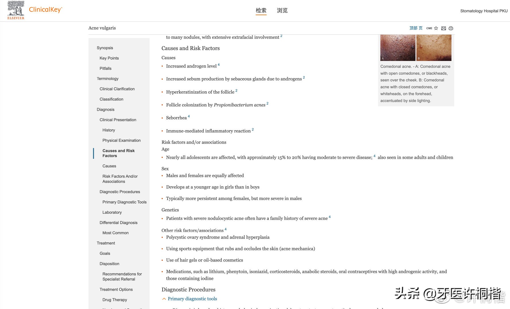 嘴唇周边长痘痘是用了含氟牙膏吗,唇周围长痘不要用含氟牙膏