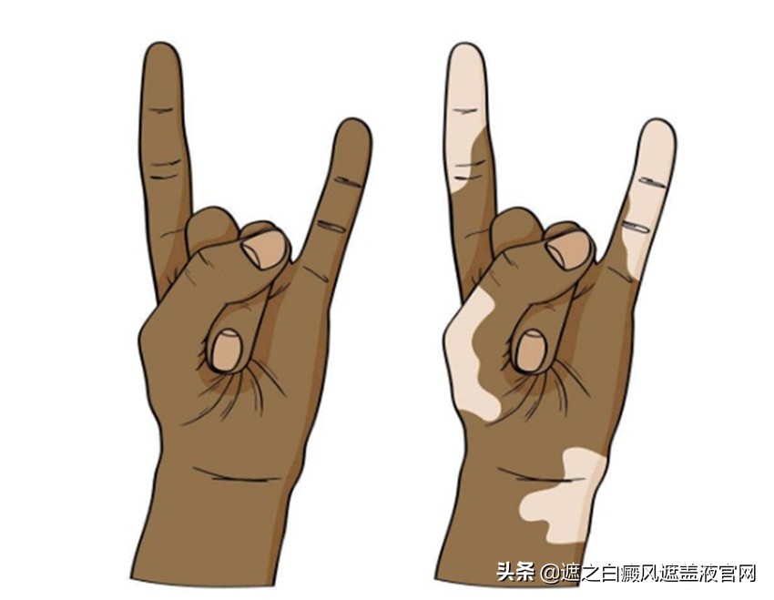 308激光治疗白癜风怎样算是有效果,他克莫司加308激光能治好白癜风吗