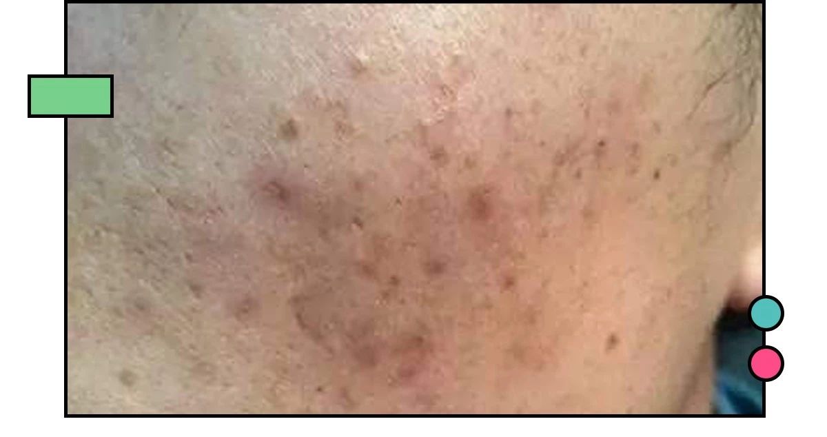 如何祛痘印？看了这篇能解决你大部分的问题！