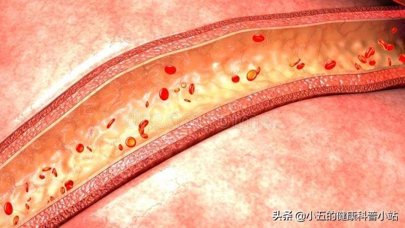 能稳定斑块的中成药,既能降压又能降脂的药