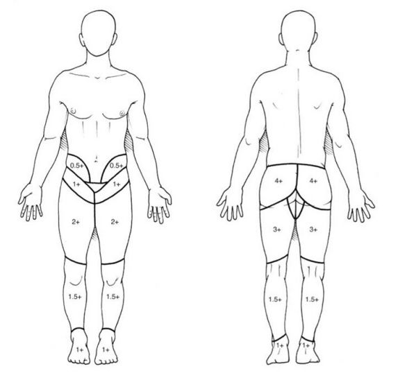 骶髂关节紊乱后复位后依然腰痛,运动康复腰椎酸痛