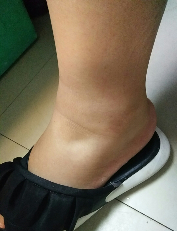 浮肿型腿怎样瘦腿,躺着快速瘦腿让腿变得又直又细