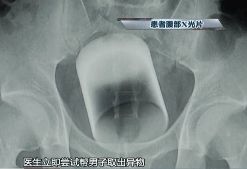 肛门塞异物很刺激？医生忙说：别乱来，快感之后全是悲伤