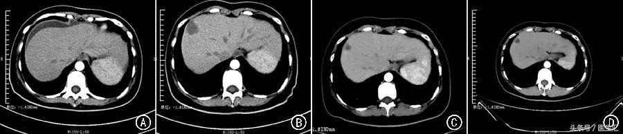 依维莫司治疗,依维莫司治肺腺癌