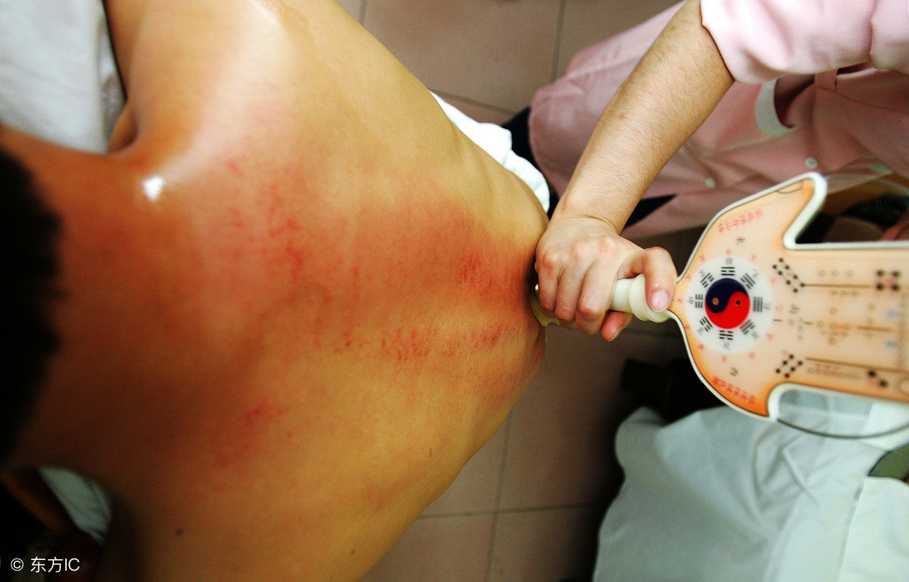 阿娇晒伤痕照称即将愈合,阿娇背部刮痧图片