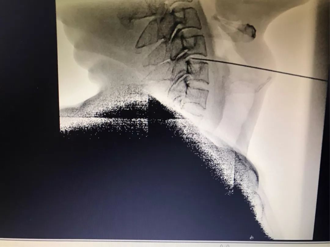 河科大一附院射频消融术,河科大一附院骨科门诊