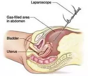 输卵管性不孕的最佳治疗方法,输卵管性不孕的中医治疗要点