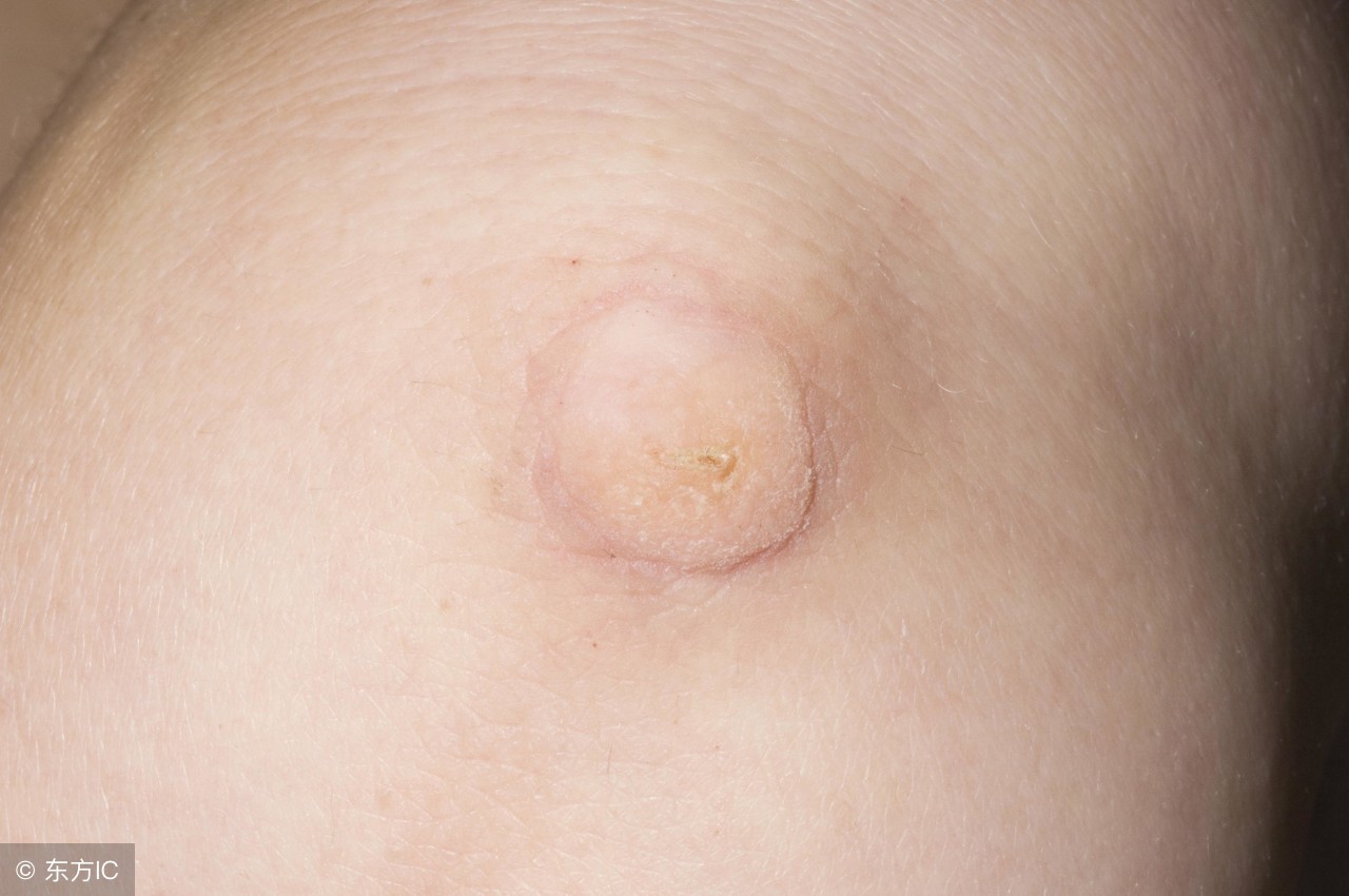 寻常疣和扁平疣区别,头皮上扁平疣和寻常疣的区别