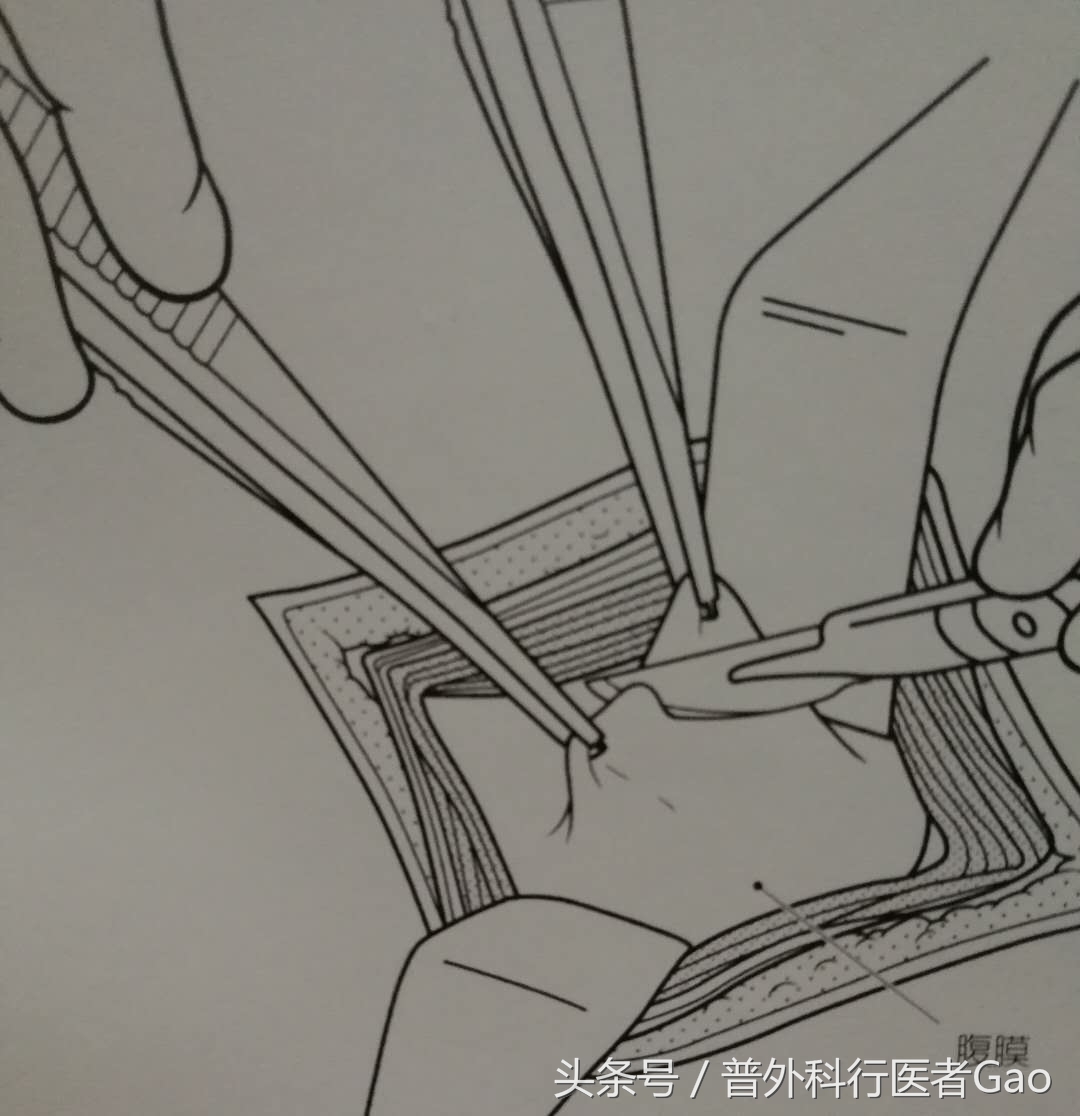 鏉忎粊鑳芥不闃戝熬鐐庡悧,鏉忎粊鍒囬櫎