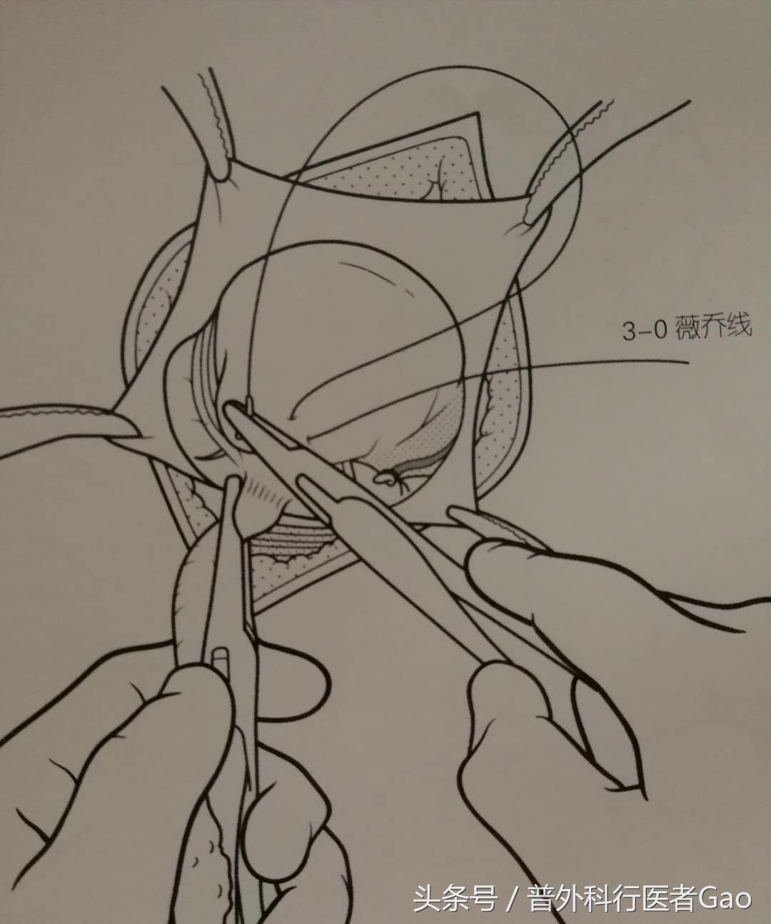 杏仁：一图一话全面解析阑尾的切除过程（干货，不懂医也学习了）
