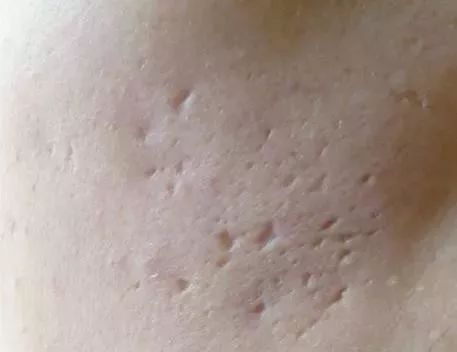 祛痘和祛痘印最好的方法,祛痘和祛痘印的方法一样吗