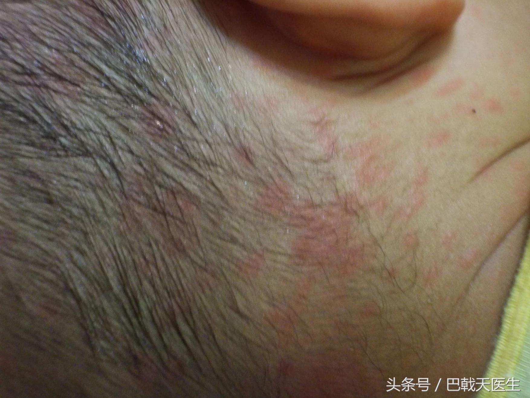 孩子出疹子宝妈需要忌口哪些,宝妈身上起疹子怎么办