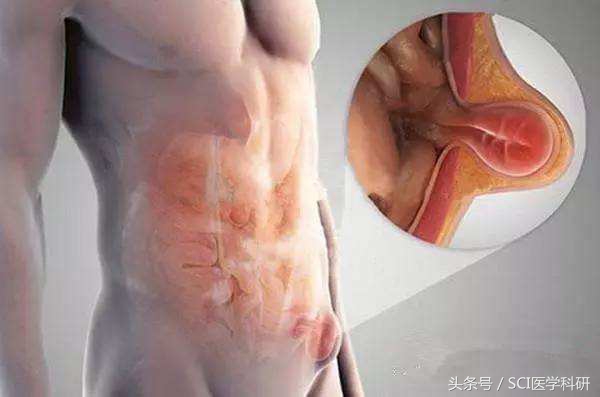疝气与腰疝有什么区别,腹部切口疝气的症状和治疗
