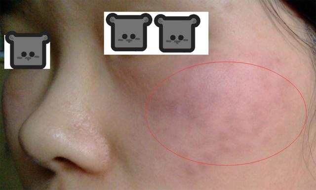 液氮祛斑和激光祛斑哪个效果好,超皮秒激光祛斑的危害与效果视频