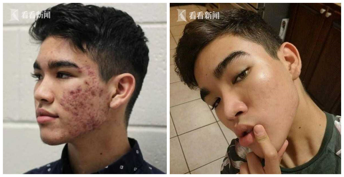 16岁男孩起青春痘用什么护肤产品,16岁男生祛痘去痘印