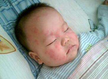 宝宝手起脓泡是怎么回事,婴儿手肿起好多小泡