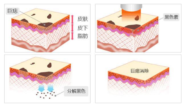 激光祛痣留下坑会长平吗,激光祛痣的疤痕会消失吗