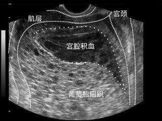 孕初期宫腔积血是什么原因引起的,怀孕9周宫腔积血先兆流产严重吗