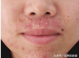 痘痘不同位置的原因及解决方法,不同阶段痘痘怎么解决