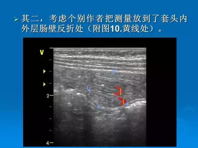 小儿肠套叠空气灌肠需要注意事项,儿童肠套叠空气灌肠要不要住院