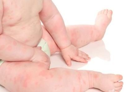 牛奶过敏3个加属于什么过敏程度,宝宝牛奶过敏和铁蛋白过敏一样吗