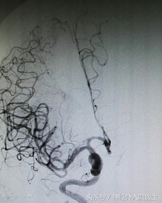 缺血性脑卒中的治疗方法有三类,缺血性脑卒中的治疗方法