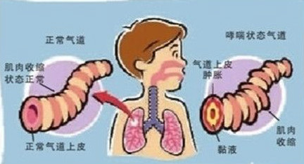怎么在家给孩子做雾化，哪些可做哪些不能做，这篇文章全说清楚了