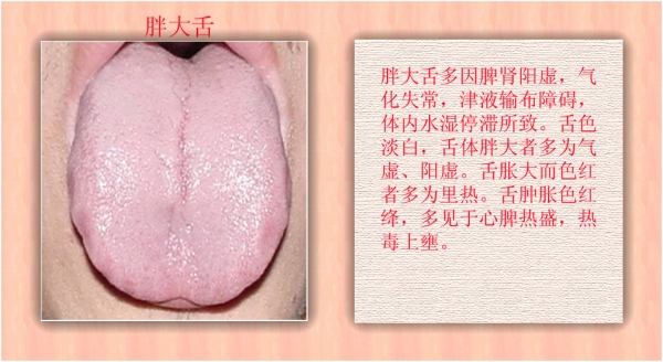 无论男女,早晨起来看看“它”,颜色越白,湿寒越重!