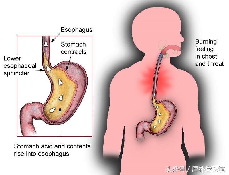反流性食管炎会不会导致ca724升高,反流性食管炎如何迅速缓解