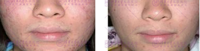 想要祛痘印用什么精华比较好,想要祛除痘印需要做什么医美