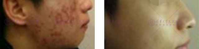 快速祛痘印小窍门真的管用,教你几招祛痘印的最快方法