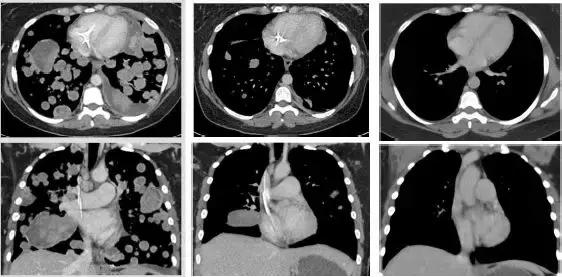 膀胱肿瘤的新疗法,最新治疗肿瘤的特效药