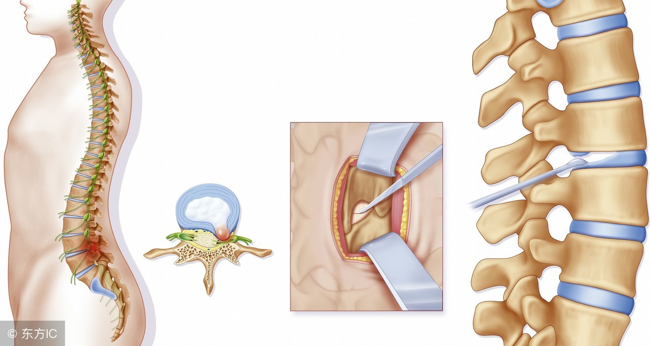 腰椎间盘突出腿痛按摩哪些穴位,腰椎间盘突出压迫神经屁股疼腿痛